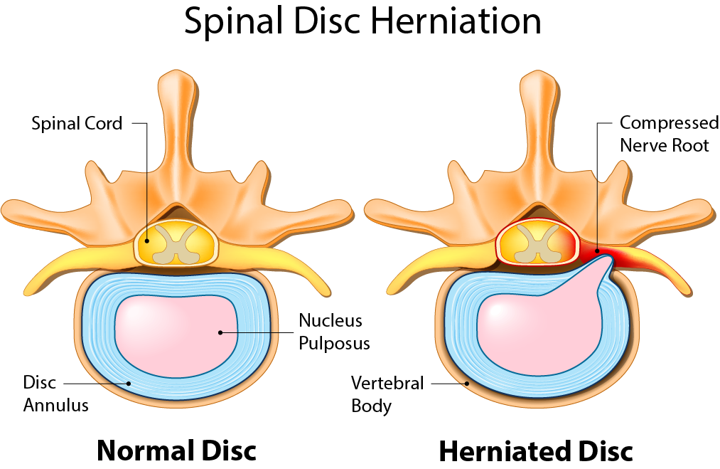 Spinal disc herniation